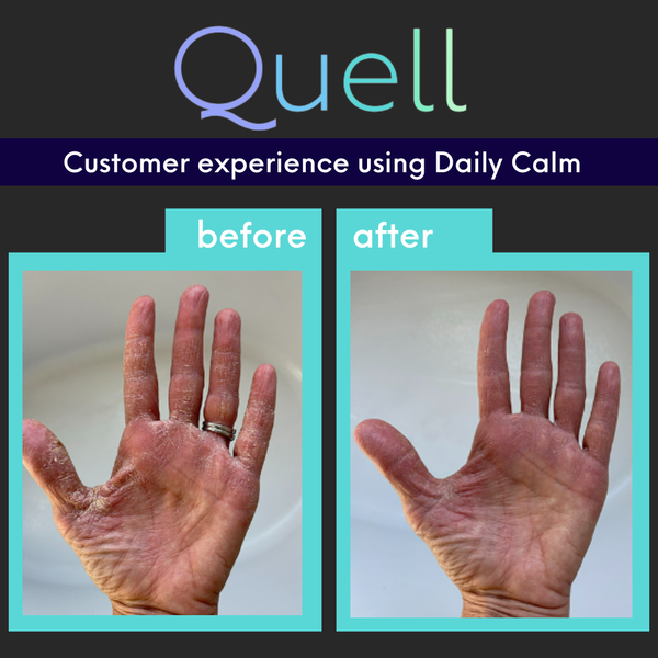 Side by side images of the same hand with red, cracked skin on the right before using Daily Calm and less red, calmer skin on the left side after using Daily Calm on a black background.